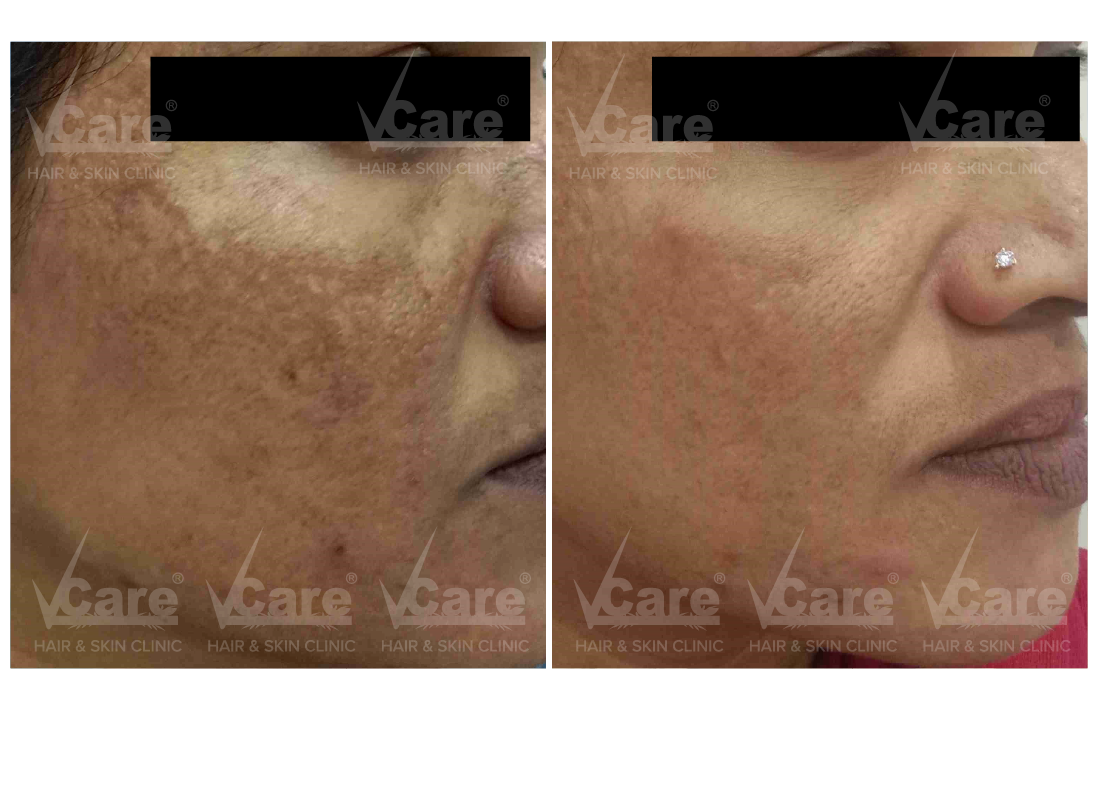 Before & After Melassence Treatment Results