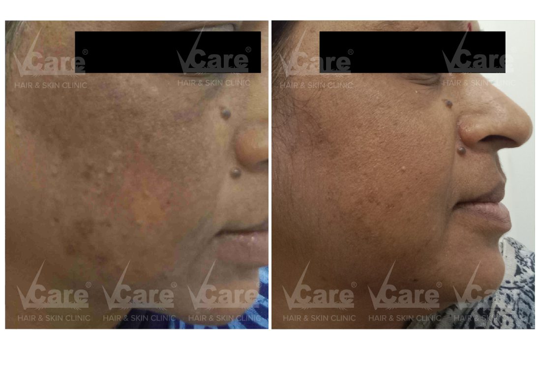 Before & After Melassence Treatment Results