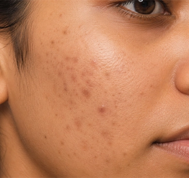 Those experiencing post-acne dark spots and PIH