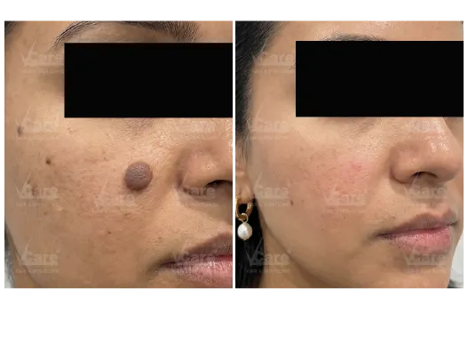 Before & After Mole Removal Treatment Results