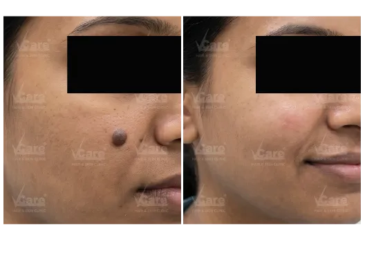 Before & After Mole Removal Treatment Results