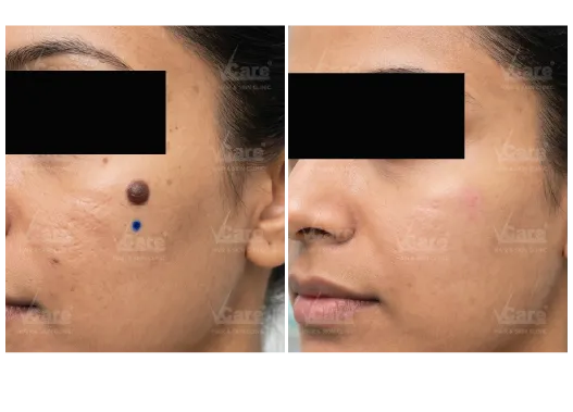 Before & After Mole Removal Treatment Results