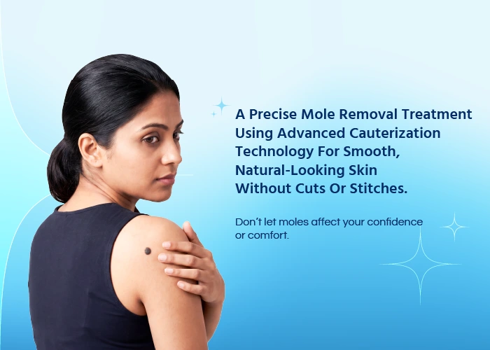 Mole Removal Treatment