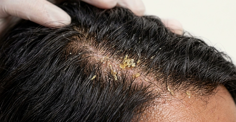 Oily Dandruff (Seborrheic)