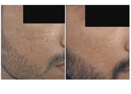 Before & After Open Pores Treatment Results