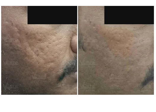 Before & After Open Pores Treatment Results