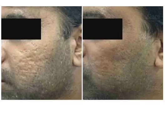 Before & After Open Pores Treatment Results