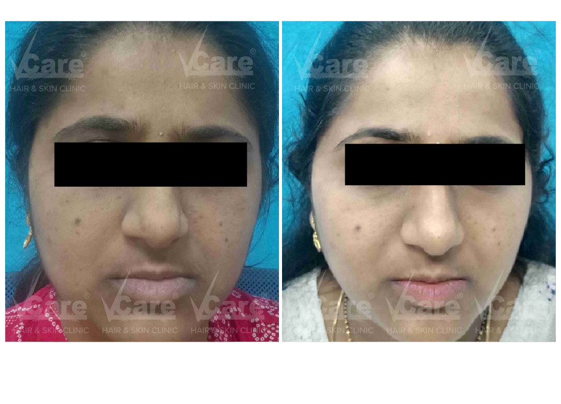 Before & After Pico Laser Treatment Results
