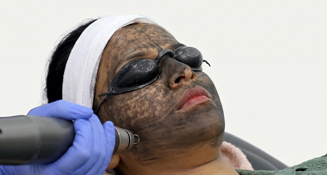 Pico Laser Procedure