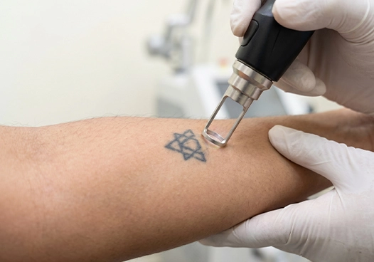 Seeking Tattoo Removal