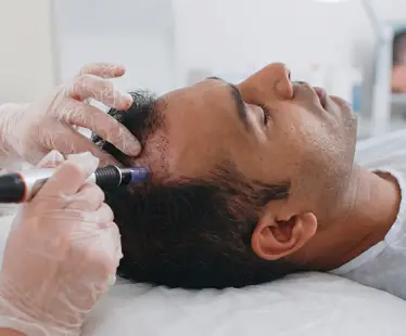 Microneedling Therapy