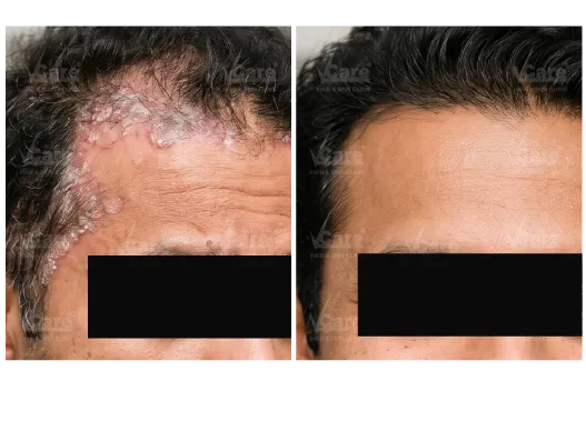Before & After Psoriasis Treatment Results