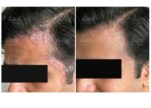Before & After Psoriasis Treatment Results
