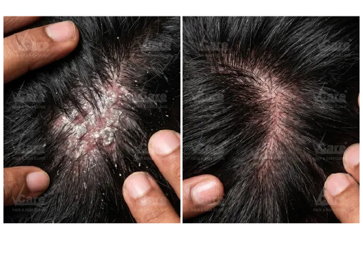 Before & After Psoriasis Treatment Results