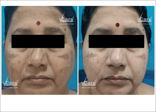 Before & After Q Switch Laser Treatment Results