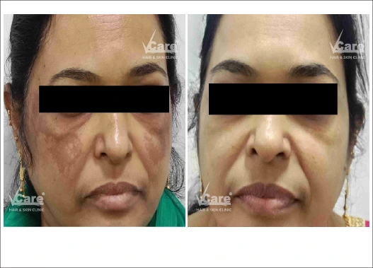 Before & After Q Switch Laser Treatment Results