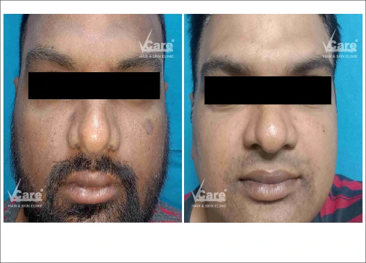 Before & After Q Switch Laser Treatment Results