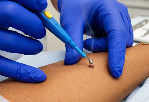 RF Cautery