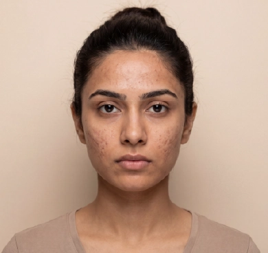Post-acne marks and uneven texture