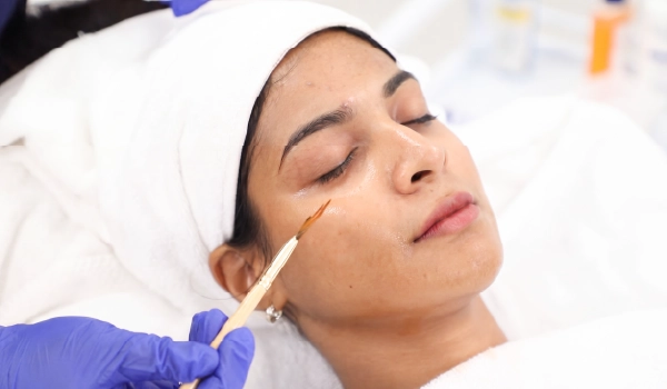 Application of Salicylic Peel (8% / 20% / 30%)