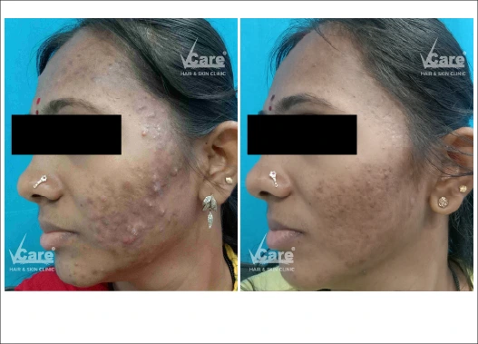 Before & After Salicylic Peel Treatment Results