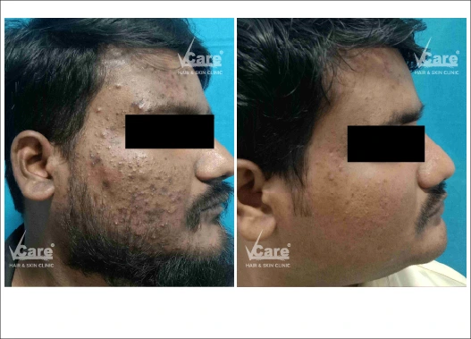 Before & After Salicylic Peel Treatment Results