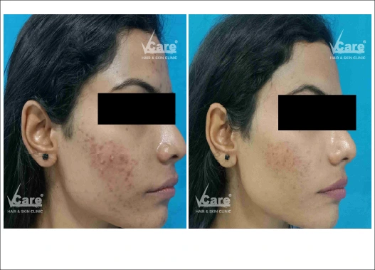 Before & After Salicylic Peel Treatment Results