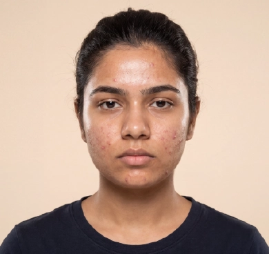 Frequent breakouts or clogged pores