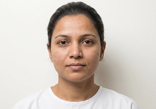 People experiencing uneven skin texture due to scarring