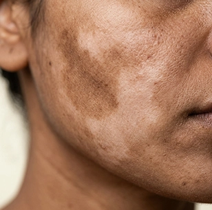 Dark or light patches on the face or body