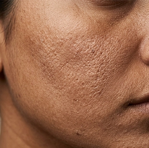 Dull and rough skin texture