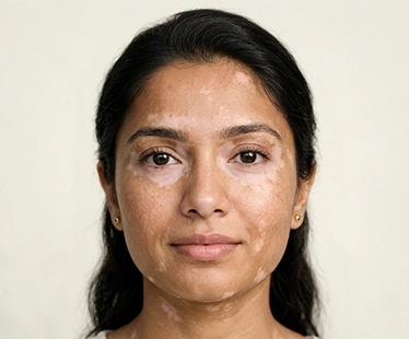 Types of Pigmentation