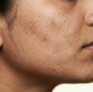 Uneven skin tone