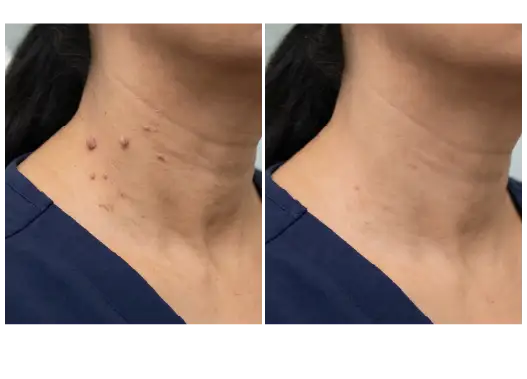 Before & After Skin Tag Removal Results