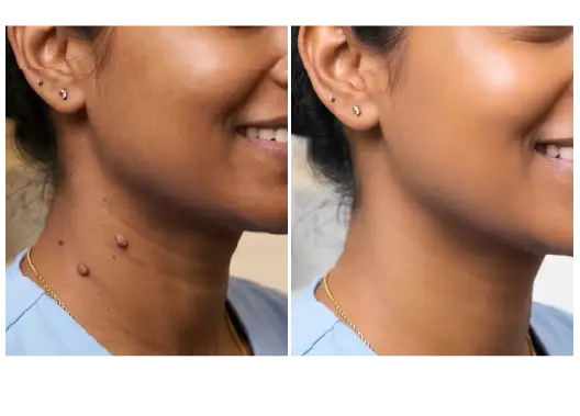 Before & After Skin Tag Removal Results