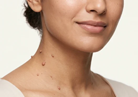 Skin tags on neck (very common)