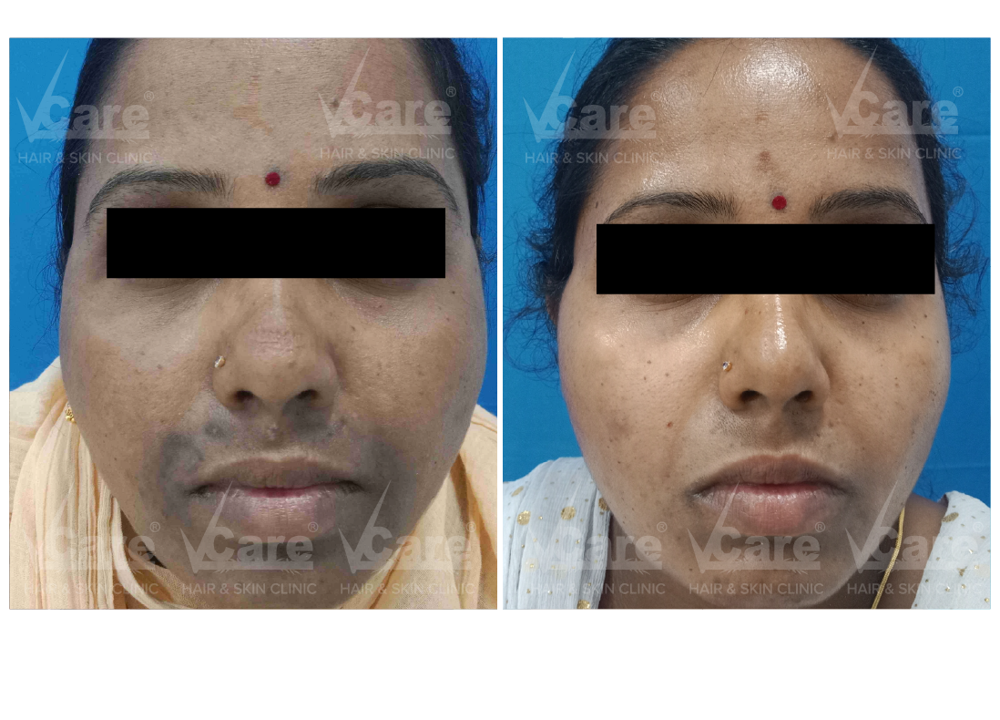 Before & After Tanned Skin Treatment Results
