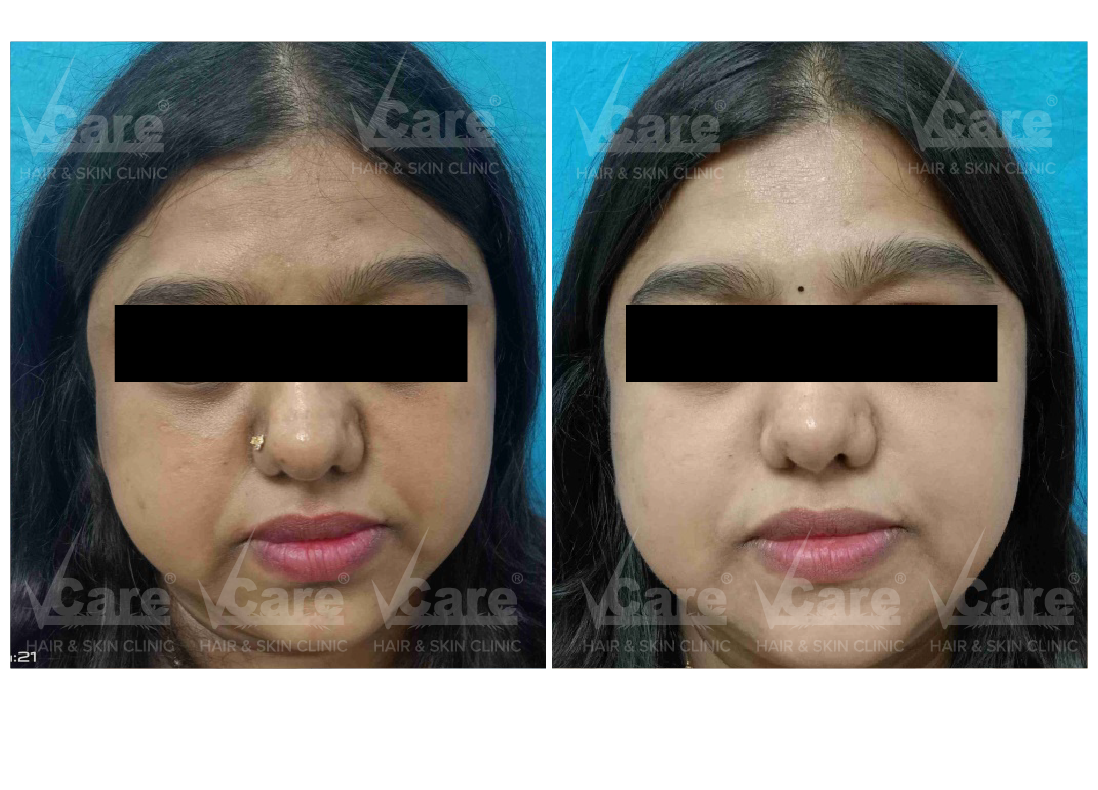 Before & After Tanned Skin Treatment Results
