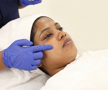 Chemical Peel for Skin Whitening