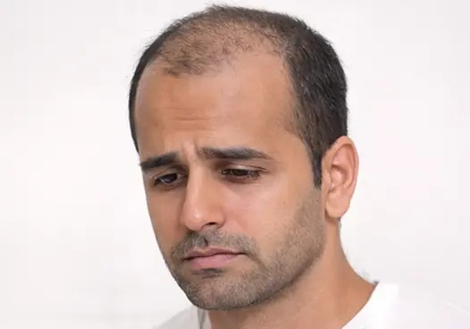 Stage 3