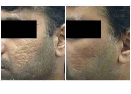 Before & After StemGen Pro™ PRP Skin Treatment Results