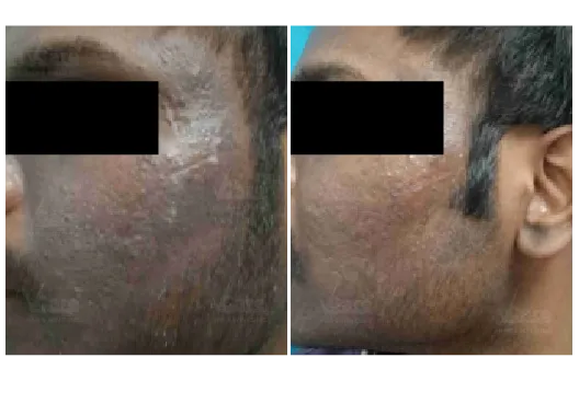Before & After StemGen Pro™ PRP Skin Treatment Results