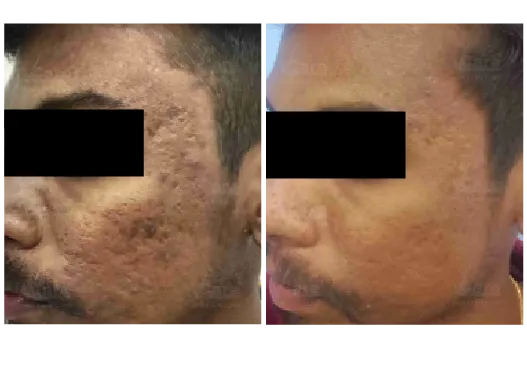 Before & After StemGen Pro™ PRP Skin Treatment Results