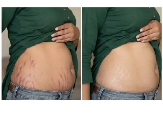 BF/AF Stretch Mark Removal Treatment Results