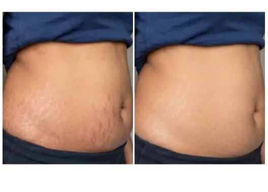 BF/AF Stretch Mark Removal Treatment Results