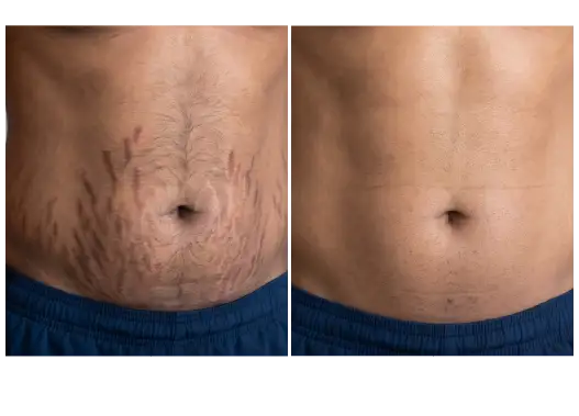 BF/AF Stretch Mark Removal Treatment Results