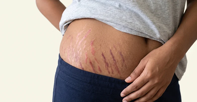 Red or Purple Stretch Marks