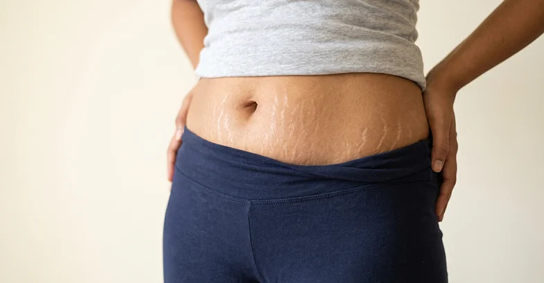 White or Silver Stretch Marks