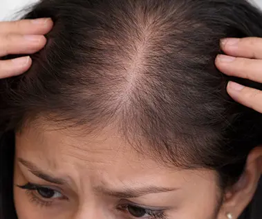 Telogen Effluvium