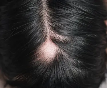 Alopecia Areata